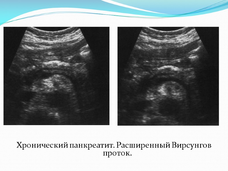 Хронический панкреатит. Расширенный Вирсунгов проток.